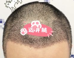 -大麦微针植发全国连锁