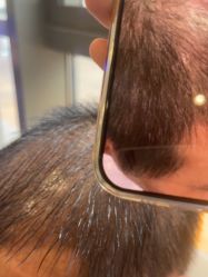 -碧莲盛·不剃发植发