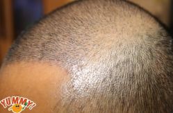 -大麦微针植发丨全国连锁