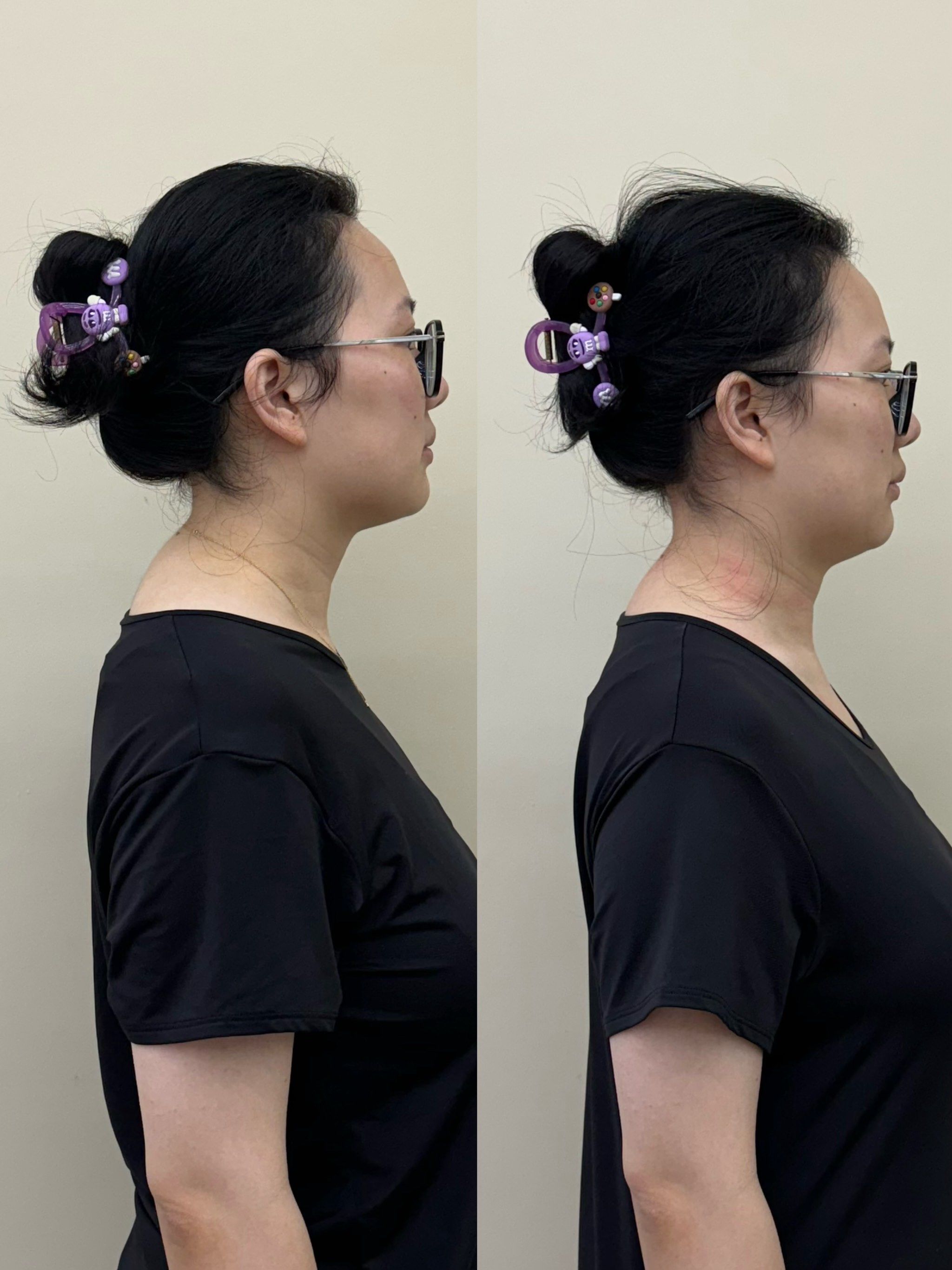 通过手法松解 训练,一节课60分钟调整富贵包前后对比图,如果勤加练习