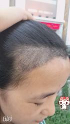 -大麦微针植发丨全国连锁