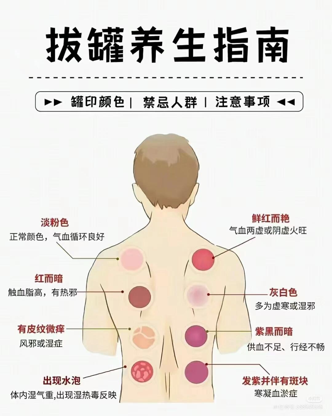 火罐颜色症状对照图图片