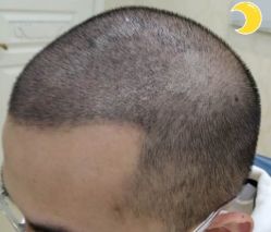 -大麦微针植发丨全国连锁