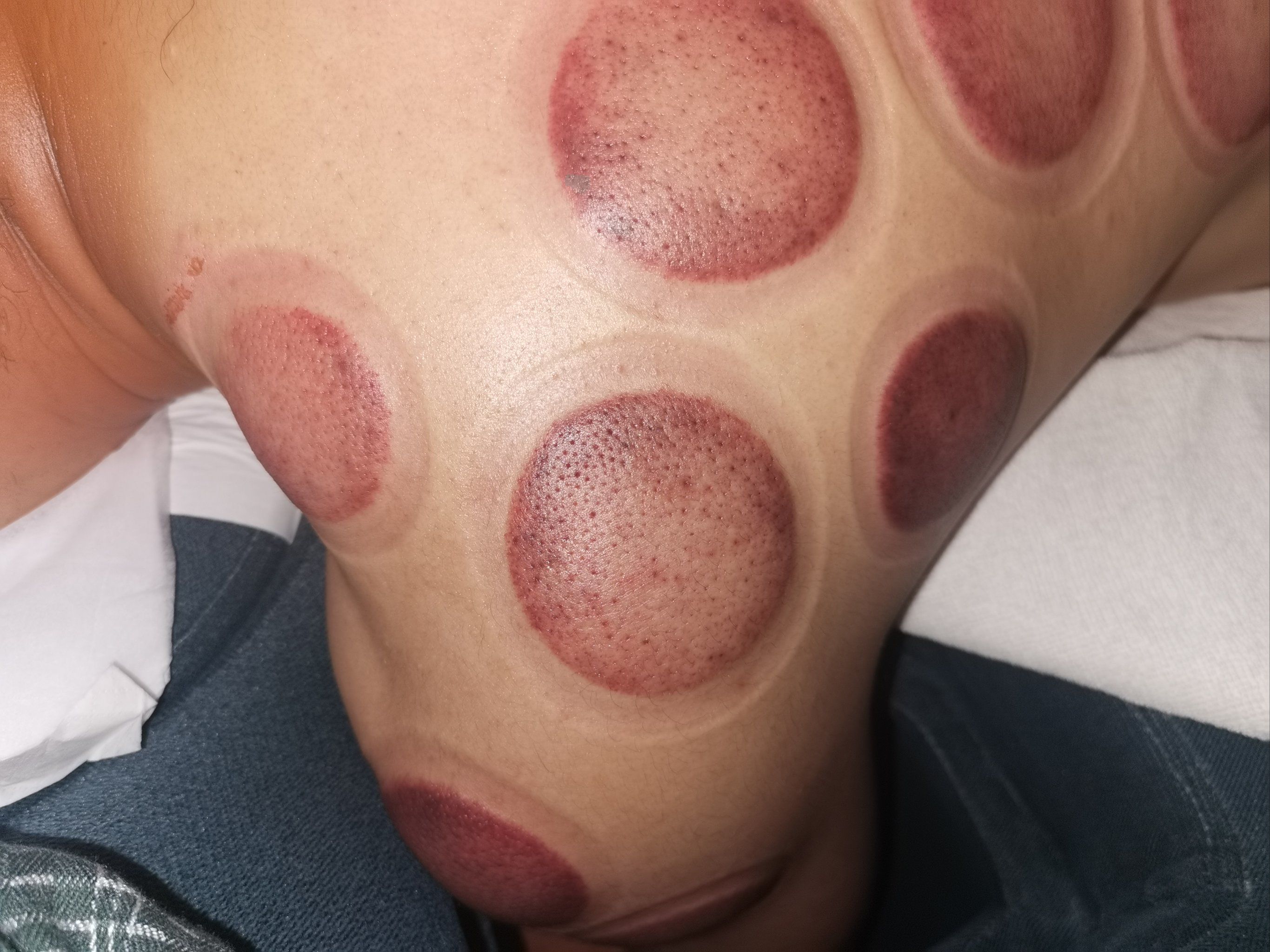 拔罐疗法,中医也能时尚!