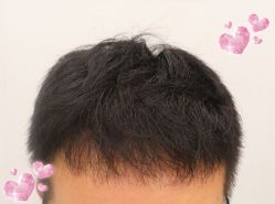 -大麦微针植发全国连锁
