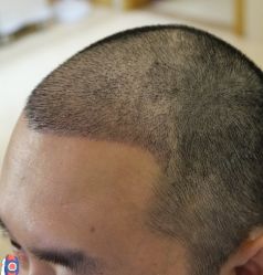 -大麦微针植发丨全国连锁