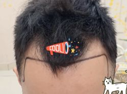 -大麦微针植发全国连锁