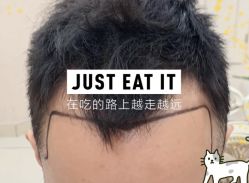 -大麦微针植发全国连锁