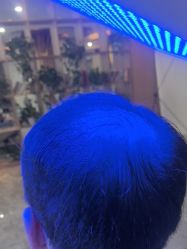 点击看大图 -碧莲盛·不剃发植发