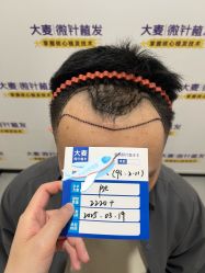 -大麦微针植发全国连锁