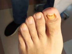 -世龙世家灰指甲鸡眼脚气甲沟炎跖疣护理(通州店)