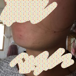-成都苗方清颜专业祛痘