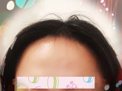 -大麦微针植发全国连锁