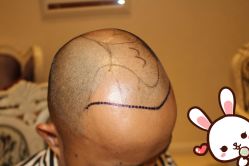 点击看大图 -大麦微针植发丨全国连锁