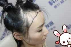 点击看大图 -大麦微针植发丨全国连锁