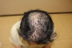 -大麦微针植发丨全国连锁