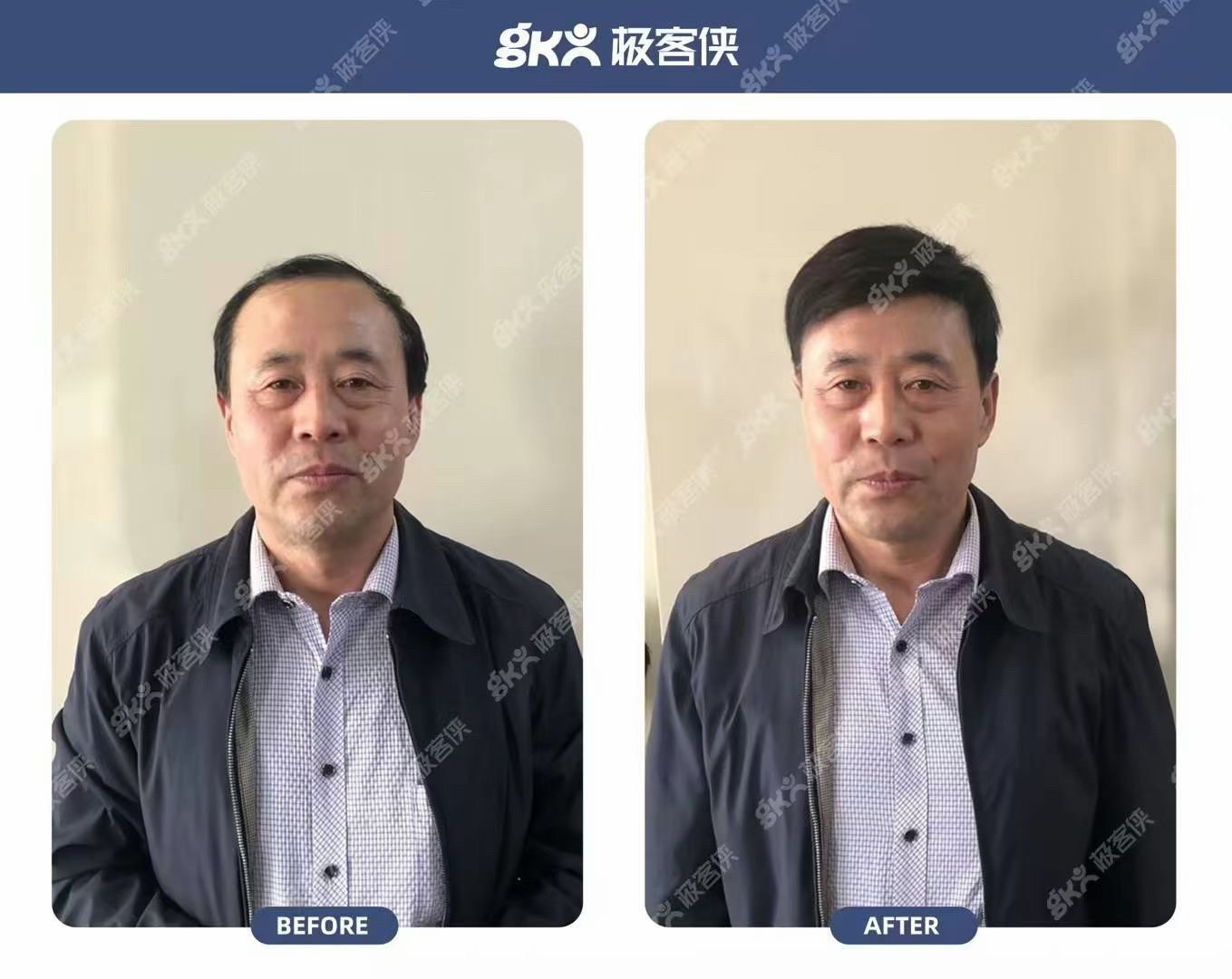 植发手术戴假发(植发后带假发会怎样)