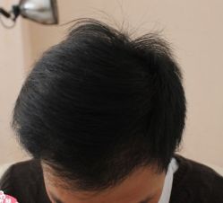 -大麦微针植发丨全国连锁