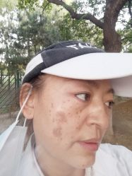 -痣清宫祛斑祛痣连锁店