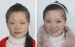 开眼角双眼皮对比-西美医疗美容门诊部
