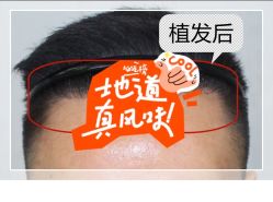 -大麦微针植发全国连锁