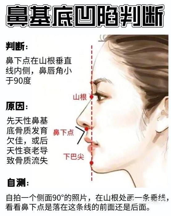 鼻基底和法令纹区别图图片