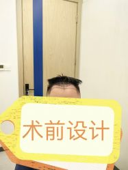 -大麦微针植发全国连锁