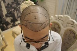 -大麦微针植发丨全国连锁