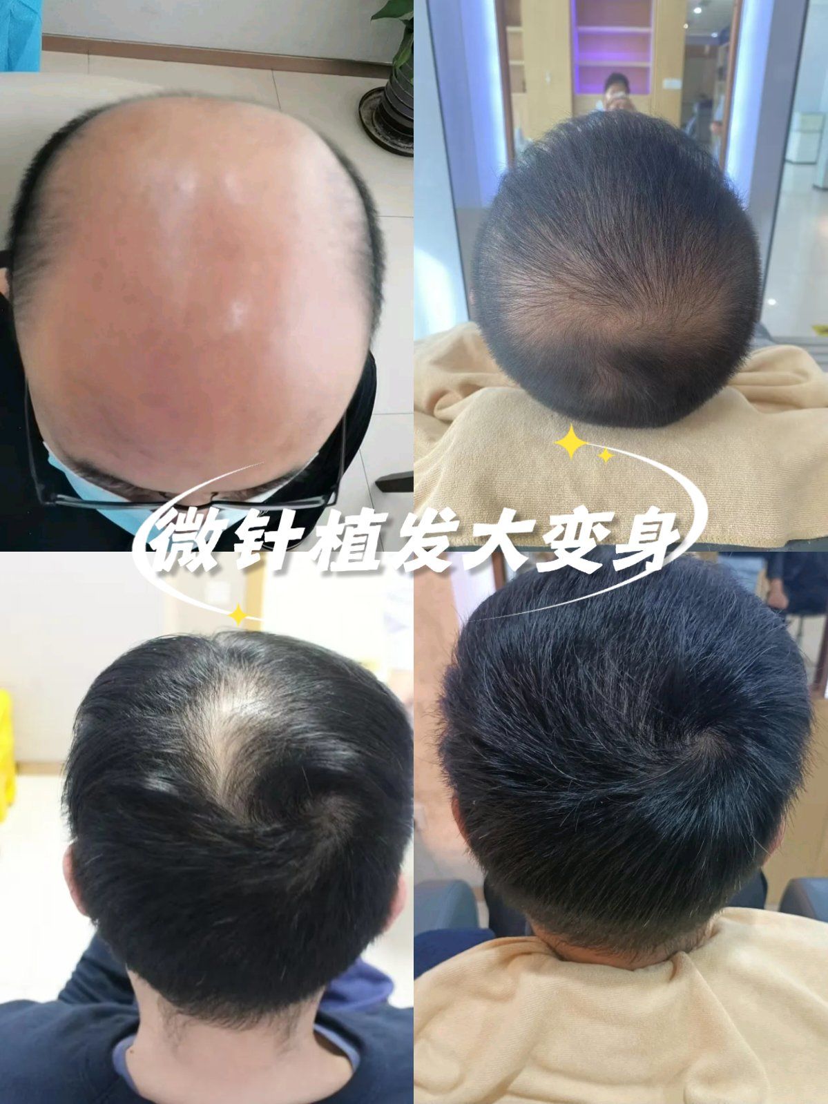 植发#微针植发#种植发际线#植发分享#大麦微针植发#植发际线#植发后