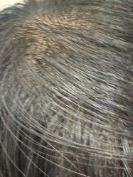 -碧莲盛·不剃发植发