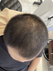 -大麦微针植发丨全国连锁