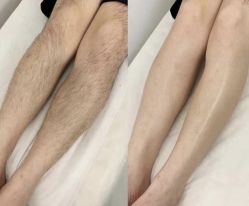 -薇兰专业脱毛连锁机构