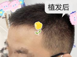 -大麦微针植发全国连锁