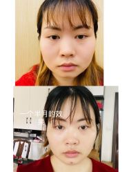 体验后-成都艾特他整形外科医院