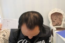 -大麦微针植发丨全国连锁