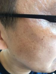 -美丽人生祛斑扁平疣汗管瘤中心