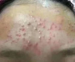 -清颜堂丨分子祛痘·功效美肤