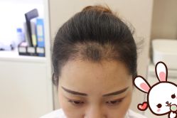 点击看大图 -大麦微针植发丨全国连锁