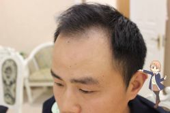 -大麦微针植发丨全国连锁