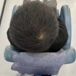 -大麦微针植发全国连锁