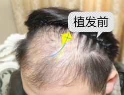 -大麦微针植发全国连锁