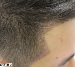 -大麦微针植发丨全国连锁