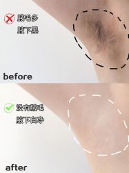 -薇兰专业脱毛连锁机构