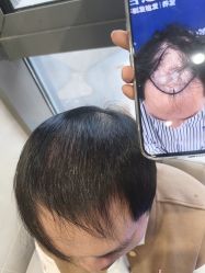 -碧莲盛·不剃发植发