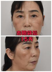 -广州健丽·去眼袋医疗美容机构