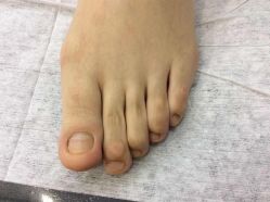 -德哥灰指甲脚气甲沟炎跖疣护理