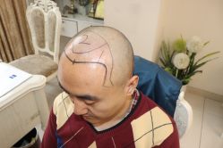 -大麦微针植发丨全国连锁