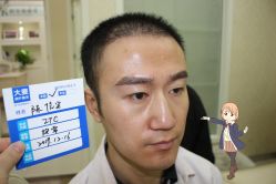 -大麦微针植发丨全国连锁