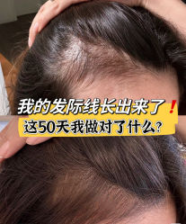 -菩叶脱发白发中心