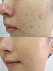 -Dr.ACNE痘院长祛痘皮肤管理全国连锁